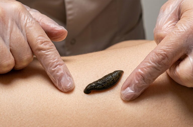 Demand for ‘Leech Therapy’ is increasing: Leeches are giving a new lease of life; diseases are being cured for just ₹50.