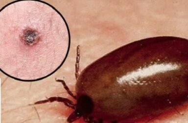 Scrub Typhus Cases Sundargarh Odisha