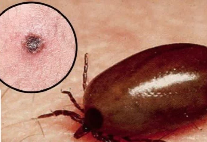 Scrub Typhus Cases Sundargarh Odisha