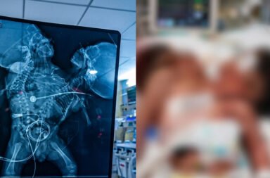Baby born with two heads on one body at MKCG Medical College.